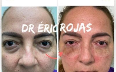 Despídete de las Ojeras con nuestra técnica.