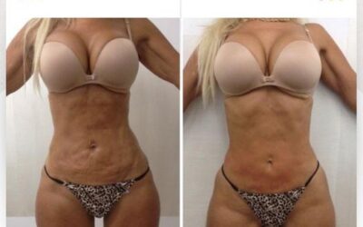 Slim Laser