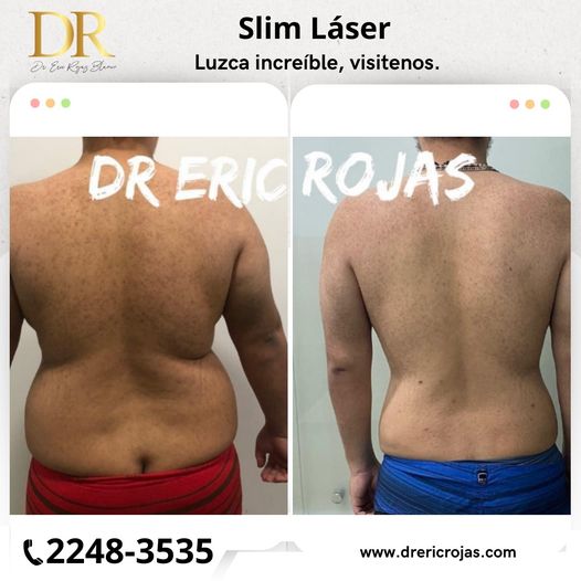 Slim Láser, resultados que puedes obtener.