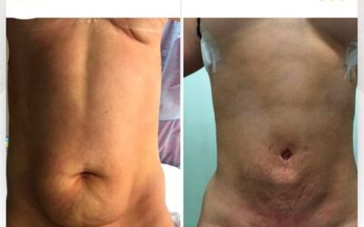 Mira los increíbles resultados del Slim Laser, ¿Qué te pareció el resultado?