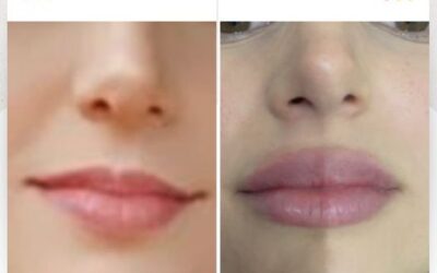 Moldeado de labios, luce tus increíbles labios.
