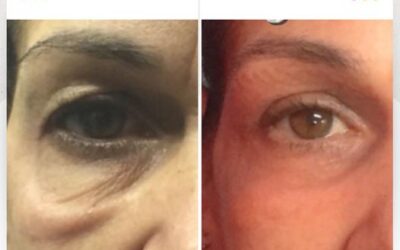 Elimina tus ojeras, mejora tu rostro.