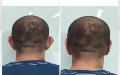 Corrección de orejas con Dermo Otoplastía.