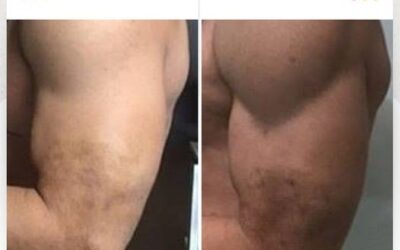 Slim Láser con resultados espectaculares.