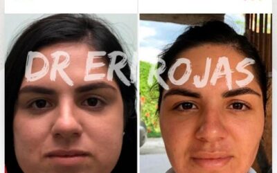 Define tu rostro con la bichectomía