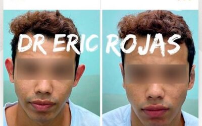 ¡Dermo Otoplastía!