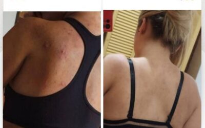 ¿Tienes acné en tu espalda?
