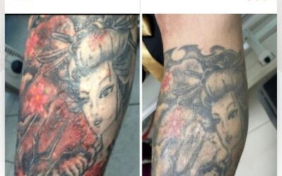 ¿Tienes problemas de piel por tus tatuajes?,