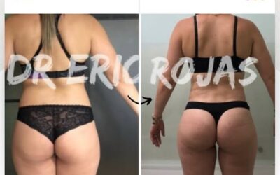 Los mejores cambios los obtienes con Slim Láser.