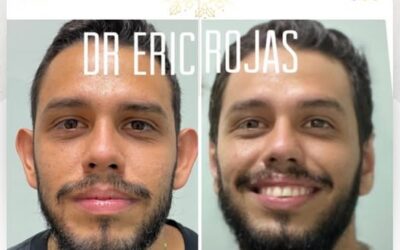 Dermo-Otoplastía para todos.