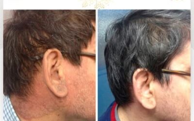 Cuida tu piel de la Psoriasis