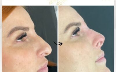 Rinolift por solo $950 dólares