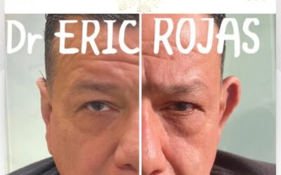 Rejuvenece tu rostro con la mejor técnica del país.