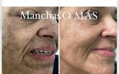 Dile adiós a las manchas con el mejor método del país.