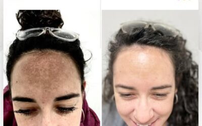 Dile adiós a las manchas de tu rostro con nuestro tratamiento.