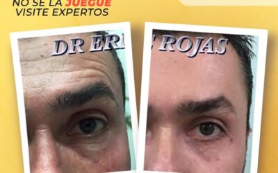 ¡Adiós a las líneas de expresión!