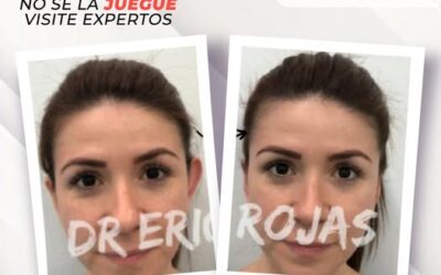 La Dermo Otoplastía te ayudará a mejorar la apariencia de tus orejas.