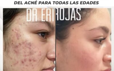 ¡Centro especializado en tratamiento para el acné! Más de 25 años como líderes con el mejor tratamiento del país.