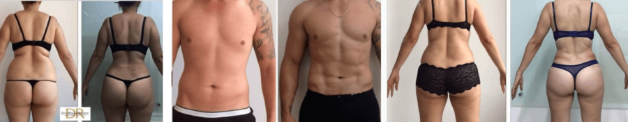 Tratamiento Slim Láser del Dr. Eric Rojas para moldear la figura