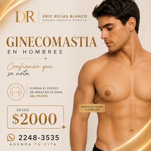 Ginecomastia