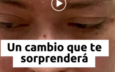 Muchas veces los problemas de piel pueden generar baja autoestima hasta depresión