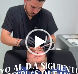 La mejor opción para todas esas arruguitas que salen es el botox