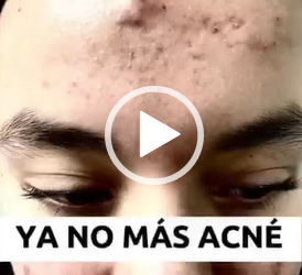 Convertimos una piel con acné a una piel de porcelana