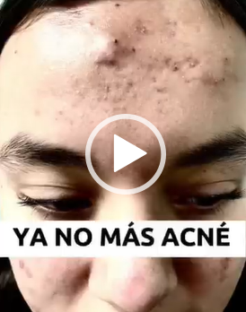 Convertimos una piel con acné a una piel de porcelana