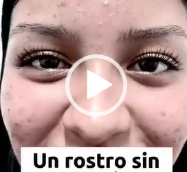 Un rostro sin acné es lo que todos los jóvenes quieren