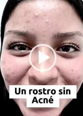 Un rostro sin acné es lo que todos los jóvenes quieren