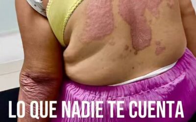 Esto es lo que casi nadie te cuenta de tener psoriasis