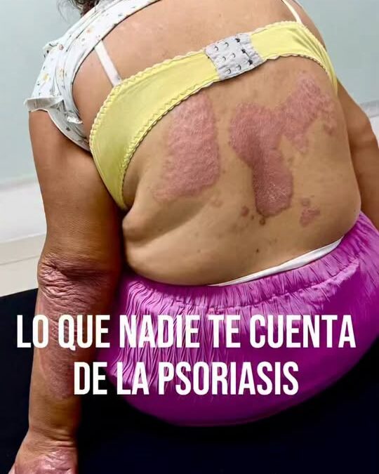 Esto es lo que casi nadie te cuenta de tener psoriasis