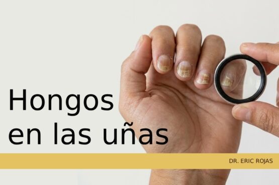 Tratamiento médico para erradicar las infecciones por hongos en las uñas