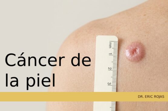 Detección temprana y mapeo de lesiones sospechosas de cáncer de piel