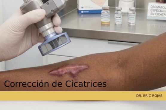 Tratamiento dermatológico para atenuar las marcas y cicatrices provocadas por el acné