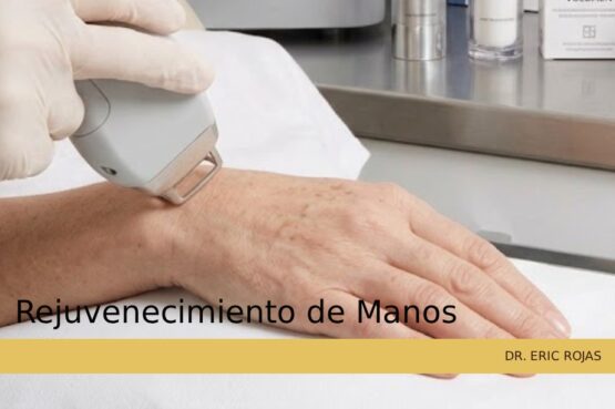Rejuvenecimiento de manos: restauración del volumen y la firmeza de la piel