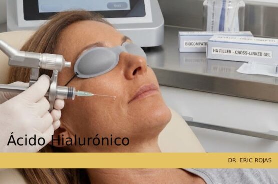 Rellenos dérmicos inyectables con ácido hialurónico para restaurar el volumen facial