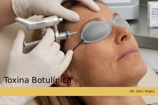 Toxina botulínica para relajar los músculos faciales y suavizar las arrugas
