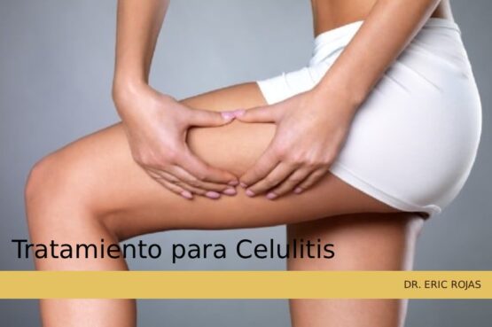 Tratamiento integral contra la celulitis y la retención de líquidos en el cuerpo