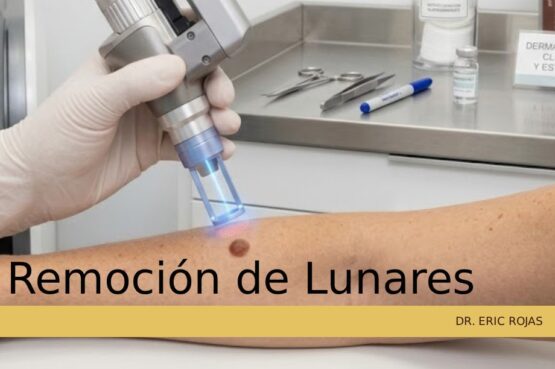 Extracción médica y estética de lunares