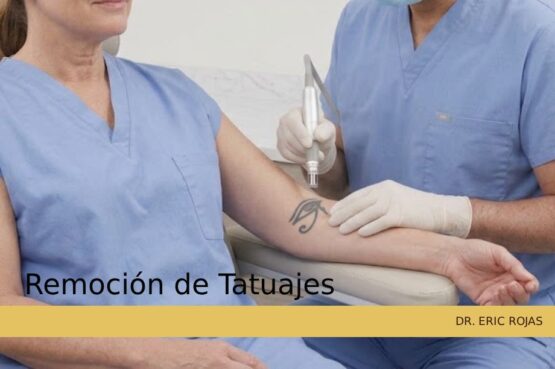 Eliminación de tatuajes con tecnología láser médica avanzada