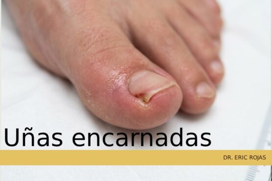 Corrección definitiva de las uñas encarnadas